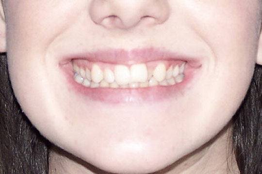 Crossbite case study 1 - before