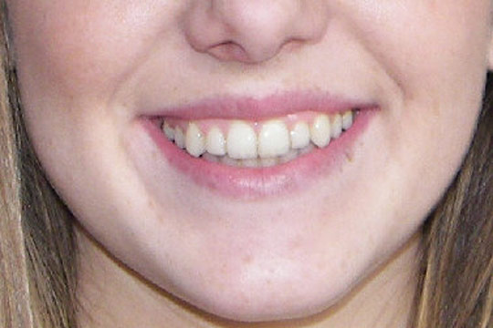 Crossbite case study 1 - after