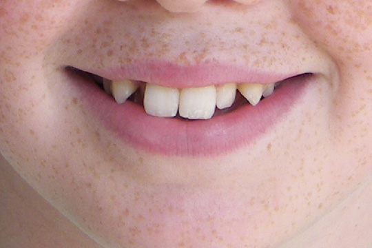 Pointed teeth case study 1 - before