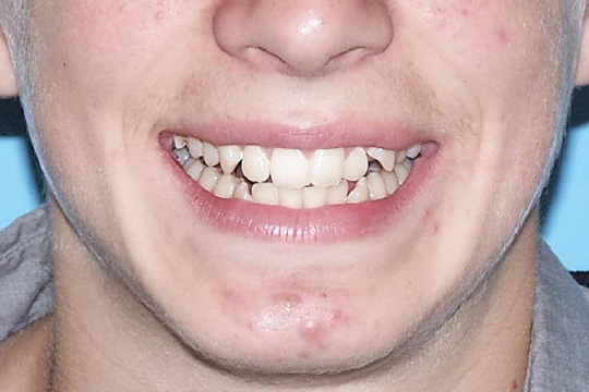 Crowded teeth case study 2 - before