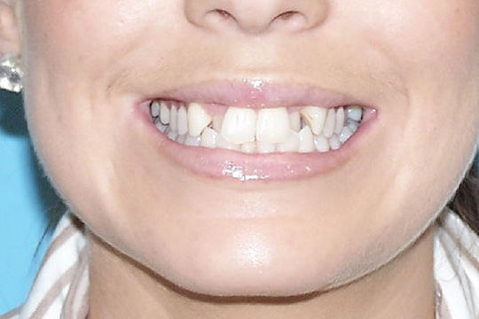 Blocked out teeth case study 2 - before