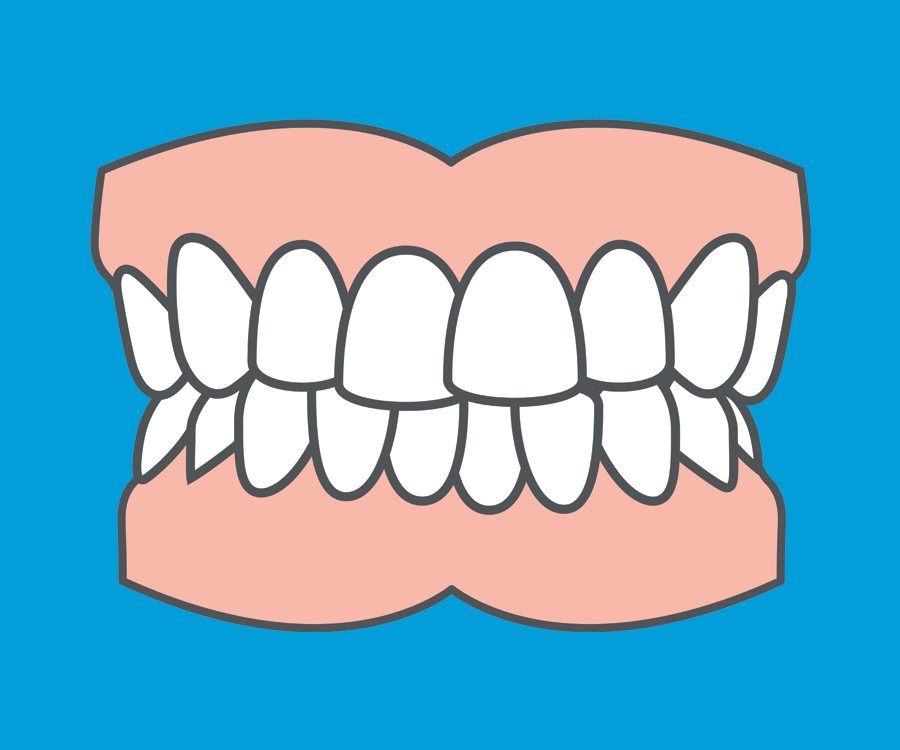 Common orthodontic problems - Crowding. Crowding can be corrected using removable or fixed braces, depending on how severe the problem is. Common orthodontic problems - Crowding. Crowding can be corrected using removable or fixed braces, depending on how severe the problem is.