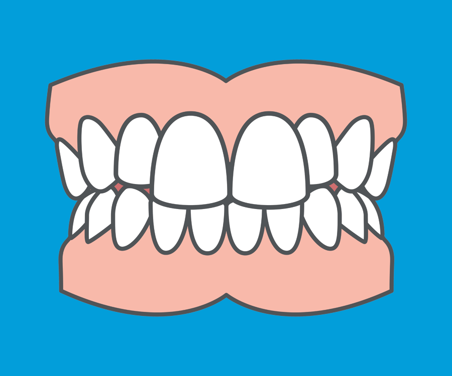Common orthodontic problems - Prominent Teeth. The most common treatment for prominent teeth is fixed braces. Common orthodontic problems - Prominent Teeth. The most common treatment for prominent teeth is fixed braces.
