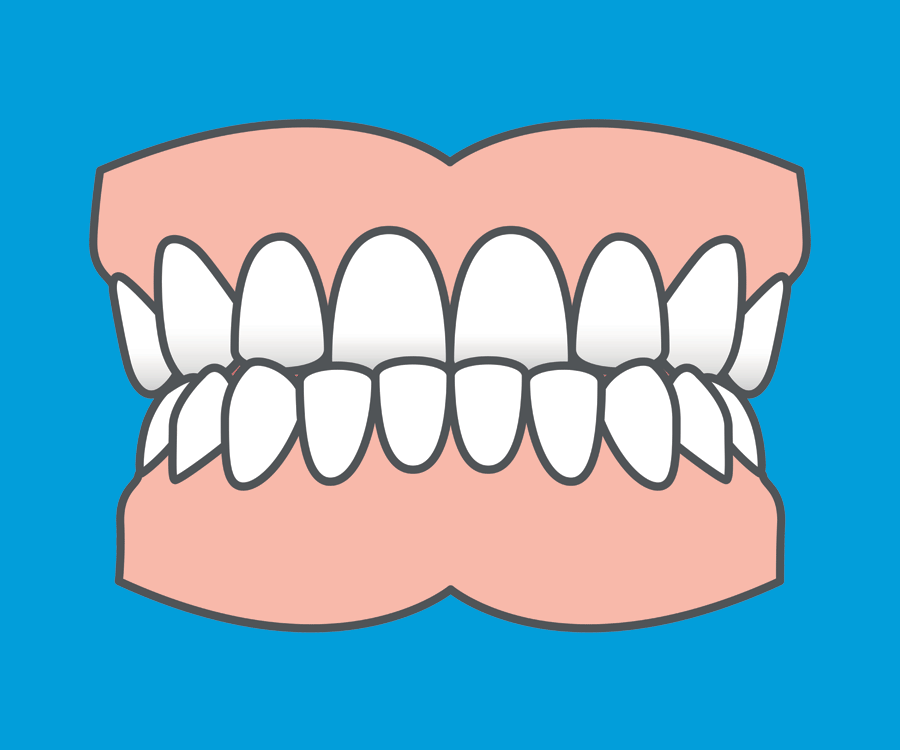 Common orthodontic problems - Underbite. Fixed and removable braces can usually fix an underbite but in some cases more complex treatment is involved. Common orthodontic problems - Underbite. Fixed and removable braces can usually fix an underbite but in some cases more complex treatment is involved.